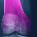 Can Glucosamine Chondroitin MSM Interact with Other Medications?