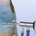 Can You Rebuild Cartilage? A Comprehensive Guide